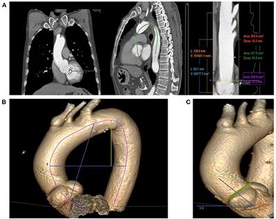 Relationship Between Length and Curvature of Ascending Aorta and Type a Dissection